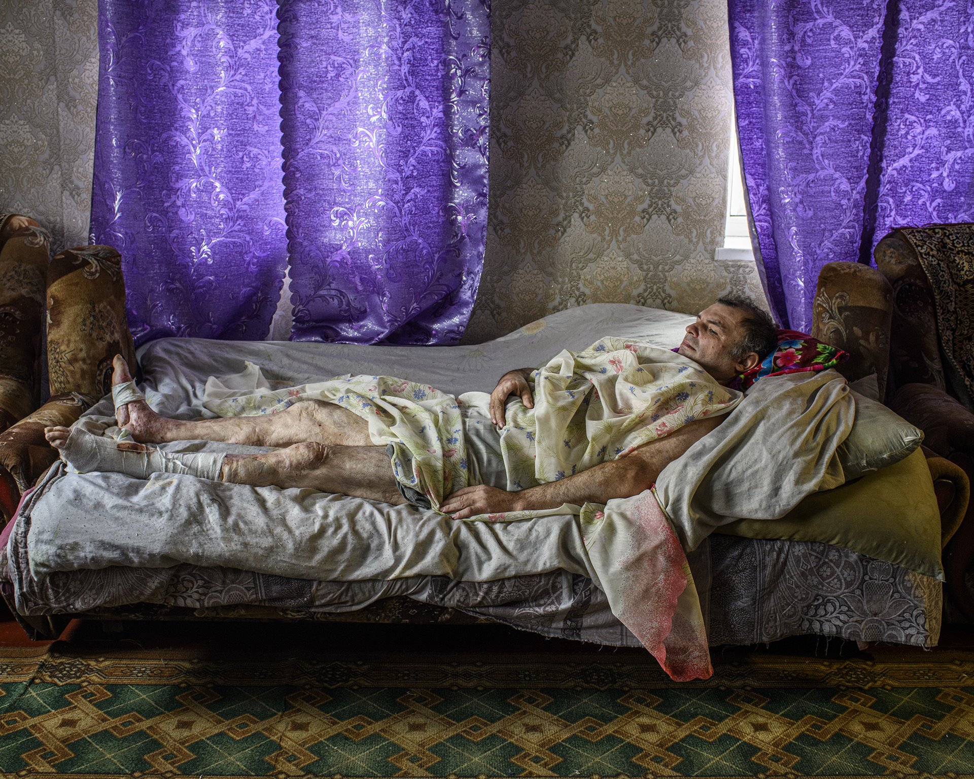 Vassili Kissilov lies in bed in Kodema, Donetsk, Ukraine. Kissilov was driving his tractor in a field near his village on 24 April 2015, when he hit a landmine. His legs were badly burned and he lost two fingers and two toes. Some of his wounds do not heal. Unexploded ordnance and mines pose a threat to people living in the Donbass region, with Reliefweb reporting more than 1,600 deaths from such explosions up to 2018.